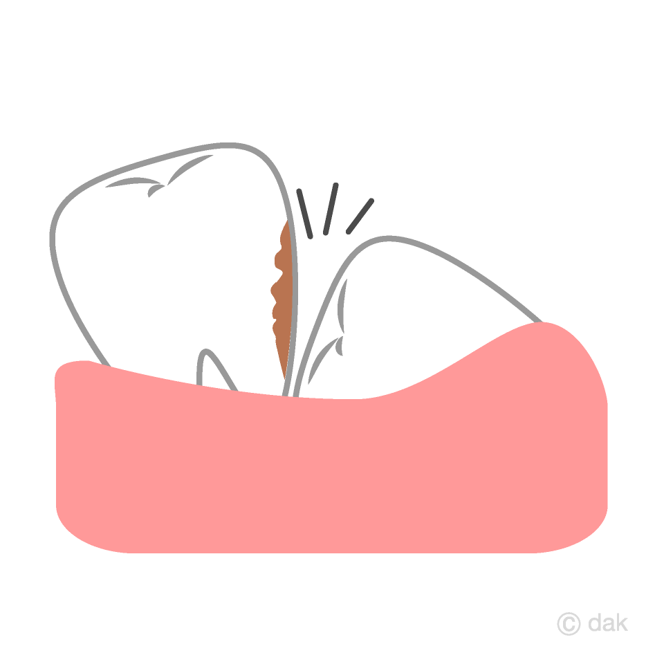 Wisdom Tooth